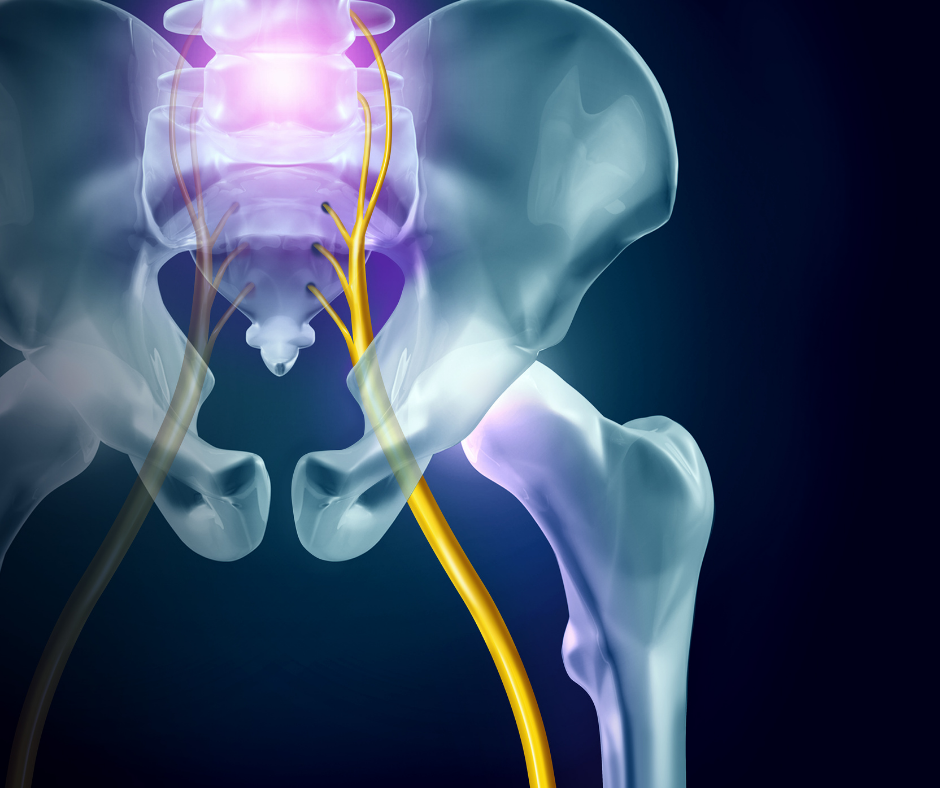 How Pilates can help with sciatica